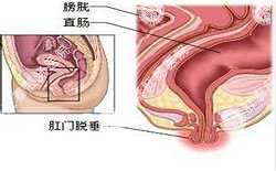 南寧治療脫肛哪家醫(yī)院好？南寧脫肛治療多少錢？